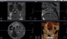 CBCT redgen